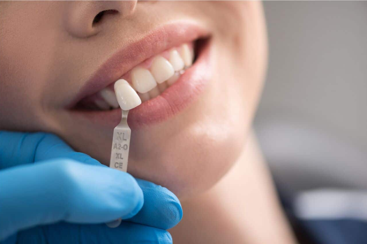 Veneers Can Address Dental Imperfections