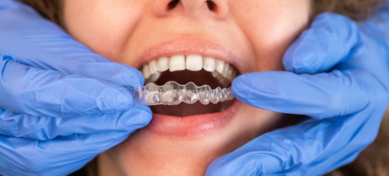 Can Invisalign Fix Gaps Between Teeth Insights for Richmond People