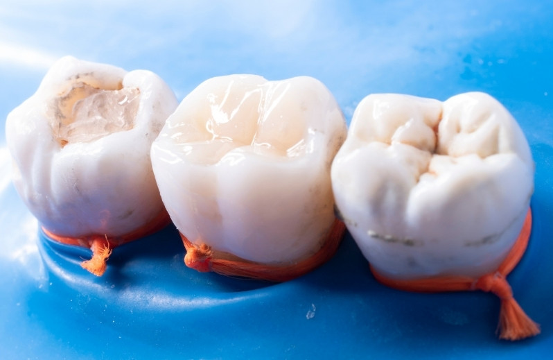 process of getting white fillings
