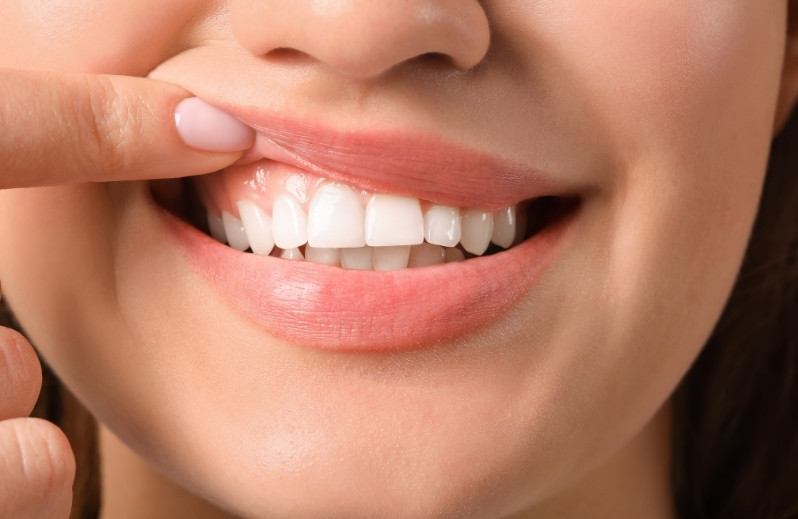 gummy smile reduction causes and how to fix